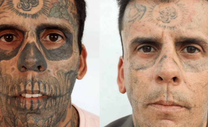 L'uomo più tatuato del Brasile rimuove i tatuaggi