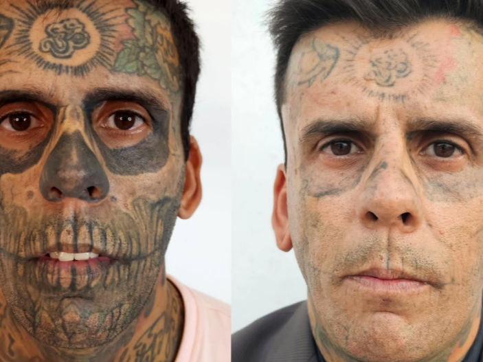 L'uomo più tatuato del Brasile rimuove i tatuaggi